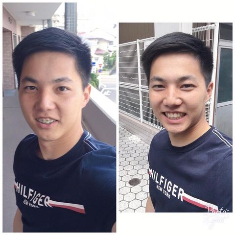 印刷可能 歯科矯正 2ch 1085 歯科矯正 2ch