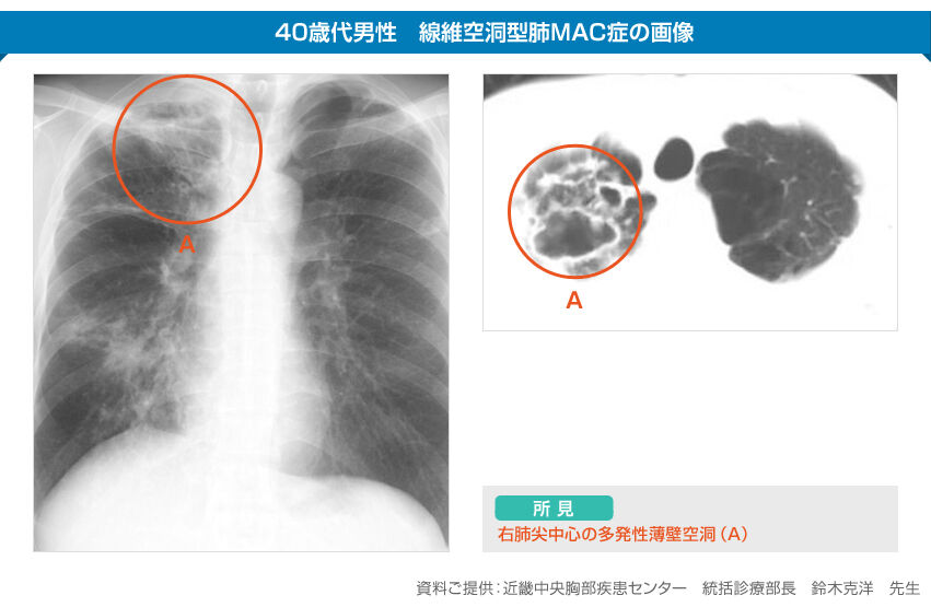 肥満と喘息の関係：秋に増える呼吸器トラブルの真実