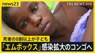 日本のワクチンが期待される中での「エムポックス」感染症の現状と対策