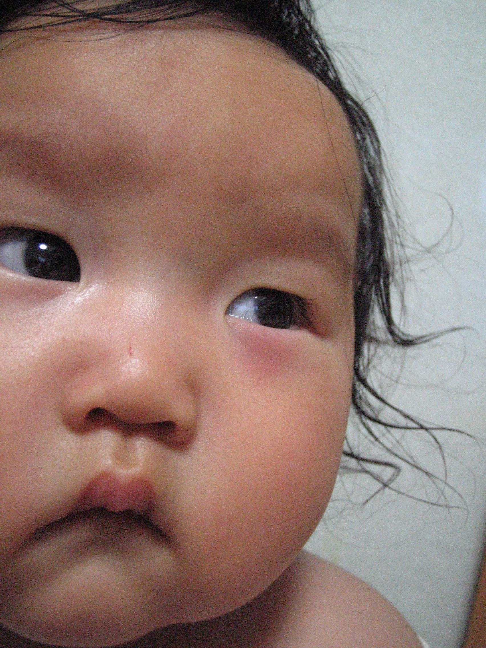 赤ちゃん 目 の 周り 赤い アレルギー