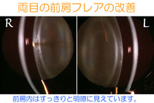 両目の前房フレアは改善されすっきりと見えています。