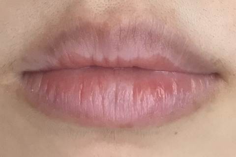 最近の唇 剥脱性口唇炎もうすぐ完治