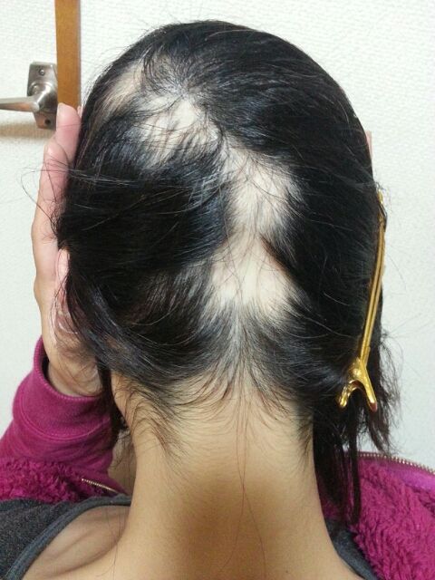 2015年3月25日 受診（産毛が生えてきてる!） : ランの円形脱毛症 ...