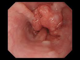 Esophageal cancer