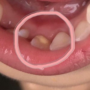 画像有り 子供 6歳年長 の永久歯の裏が黄色い 原因が判明しました 7本目の乳歯が抜けた えりゐのｅｖｅｒｙ ｄｉａｒｙ Powered By ライブドアブログ
