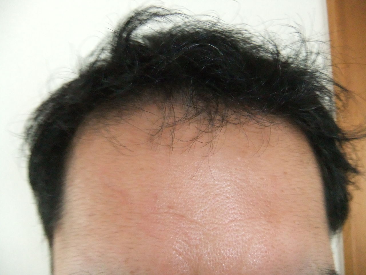 前髪が陰毛のように 編集者が送る ガチの育毛プロジェクト 前髪が陰毛のように 編集者が送る ガチの育毛プロジェクト