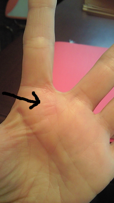 ボディ プレス やけど