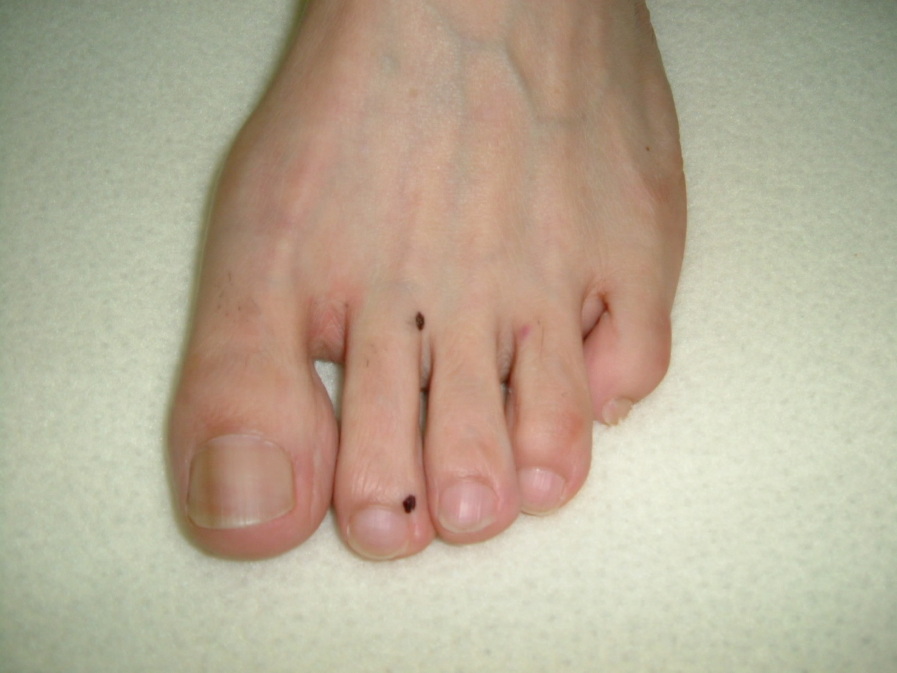 手の指の痛みを足の指で治す 鍼灸治療のq Aブログ