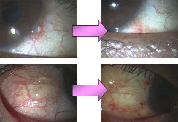 ある奈良県の眼科医が目について書いたブログ 目の病気 花粉症 アレルギー性結膜炎