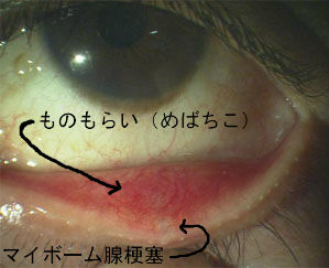 マイボーム腺梗塞 瞼に白いできもの その裏側にも白い塊がありごろごろする ものもらい めばちこ に発展することも ある奈良県の眼科医が目 について書いたブログ