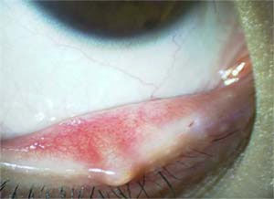 ある奈良県の眼科医が目について書いたブログ 目の病気 まぶた