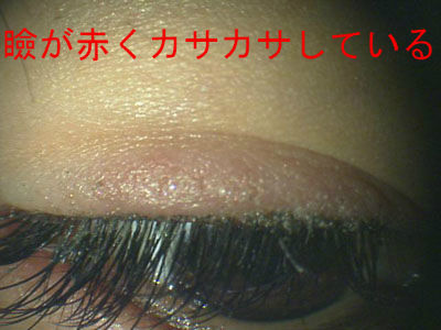 まつげエクステンション マツエク の危険性 グルー 接着剤 のアレルギーによるトラブル ある奈良県の眼科医が目について書いたブログ