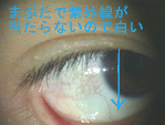 紫外線で目が真っ赤に さらにひどくなったり そのままにしておくとこんなことに 紫外線と充血 その1 ある奈良県の眼科医が目 について書いたブログ 紫外線で目が真っ赤に さらにひどくなったり そのままにしておくとこんなことに 紫外線と充血 その1 ある奈良県の眼科医が目 について書いたブログ