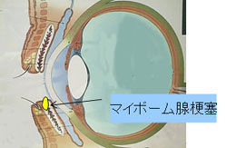 マイボーム腺梗塞 瞼に白いできもの その裏側にも白い塊がありごろごろする ものもらい めばちこ に発展することも ある奈良県の眼科医が目について書いたブログ マイボーム腺梗塞 瞼に白いできもの その裏側にも白い塊がありごろごろする ものもらい めばちこ に発展することも ある奈良県の眼科医が目について書いたブログ