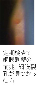 コンタクトの定期検査でこんな病気が見つかることも 近視の方に多い網膜剥離 緑内障 ある奈良県の眼科医が目について書いたブログ