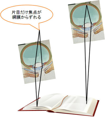 片目だけ近視が進行するのはなぜ 視力の左右差の原因と対策 ある奈良県の眼科医が目について書いたブログ