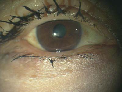 まつげ美容液 ラティース ルミガン リバイタラッシュ の危険性 充血が治らなくなったりまぶたにシミができたり くぼんできたり ある奈良県の眼科医が目について書いたブログ