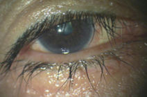 lash