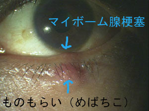 マイボーム腺梗塞 瞼に白いできもの その裏側にも白い塊がありごろごろする ものもらい めばちこ に発展することも ある奈良県の眼科医が目について書いたブログ