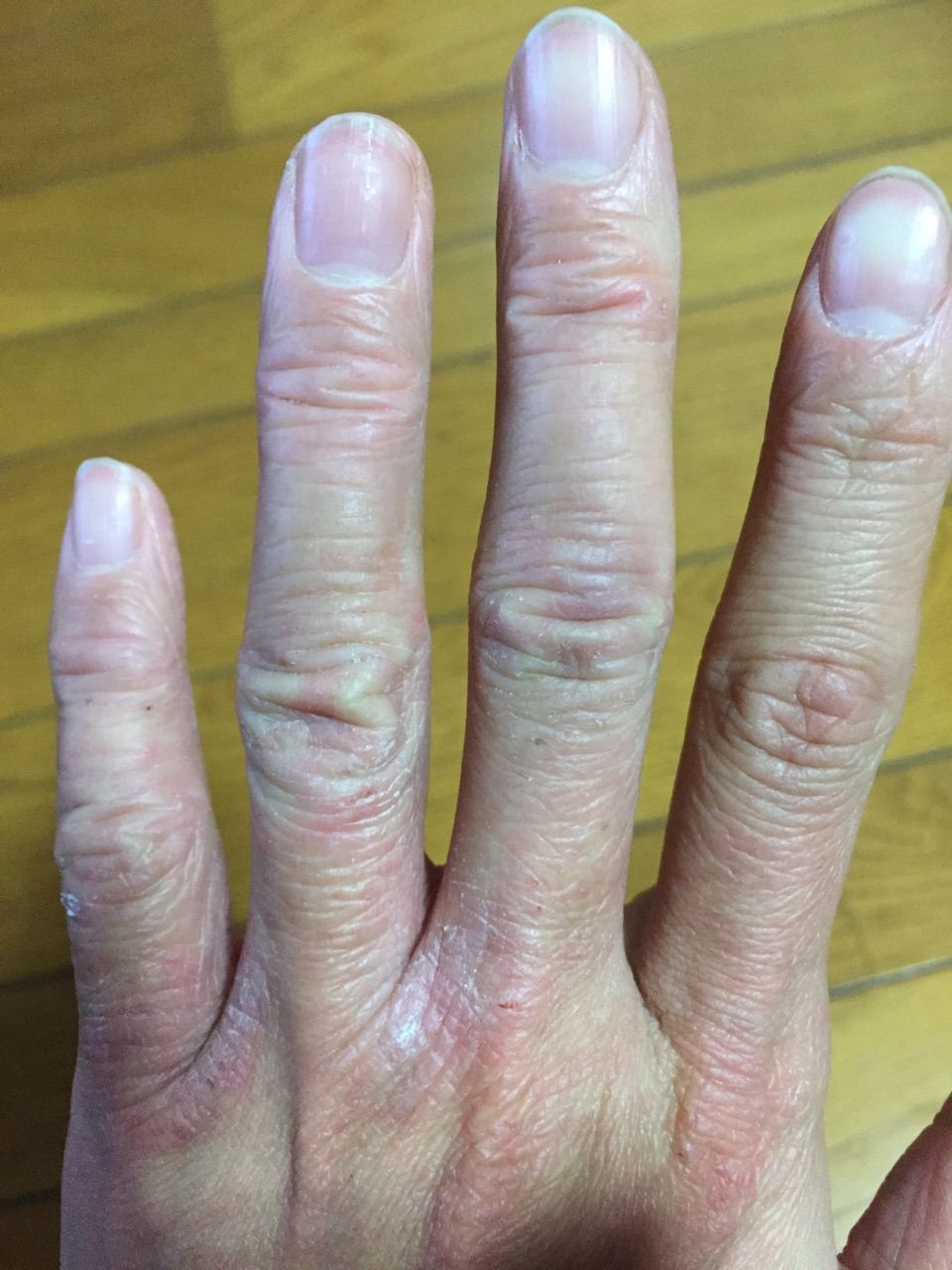 手湿疹 主婦湿疹と言うよりアトピー肌なう 比較 アトピーと手湿疹の備忘録