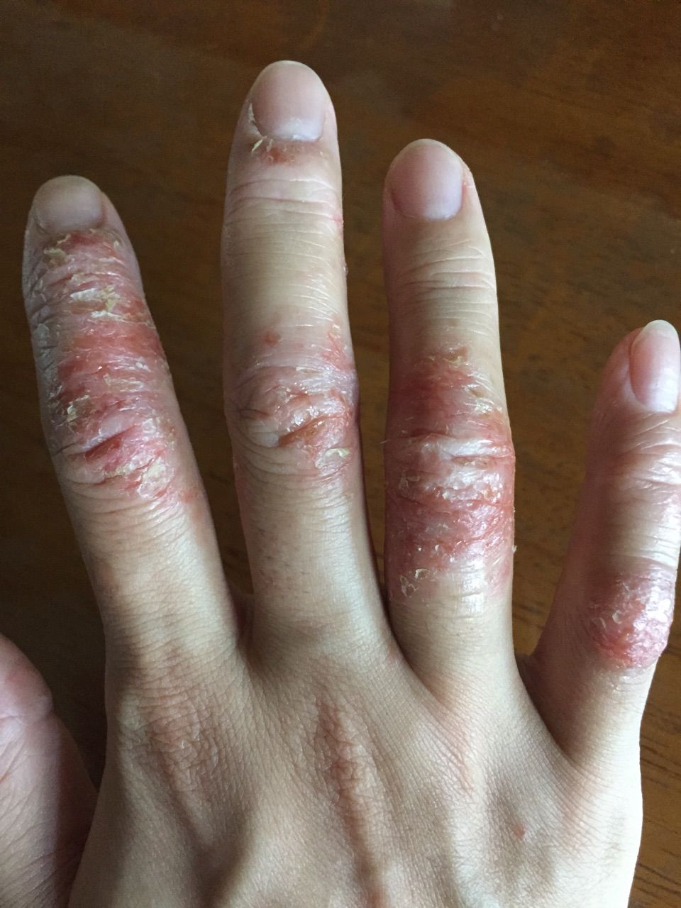 手湿疹は痛くて痒くて滲出液 アトピーと手湿疹の備忘録
