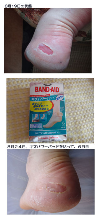 キズパワーパッドで靴ずれを治療してみました 写真の修復複製 証明写真の写真スタジオ ファジィフォト