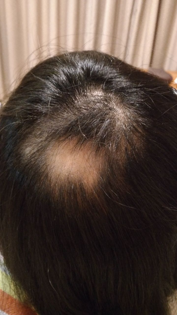 円形脱毛症 私の生活と実家の後始末