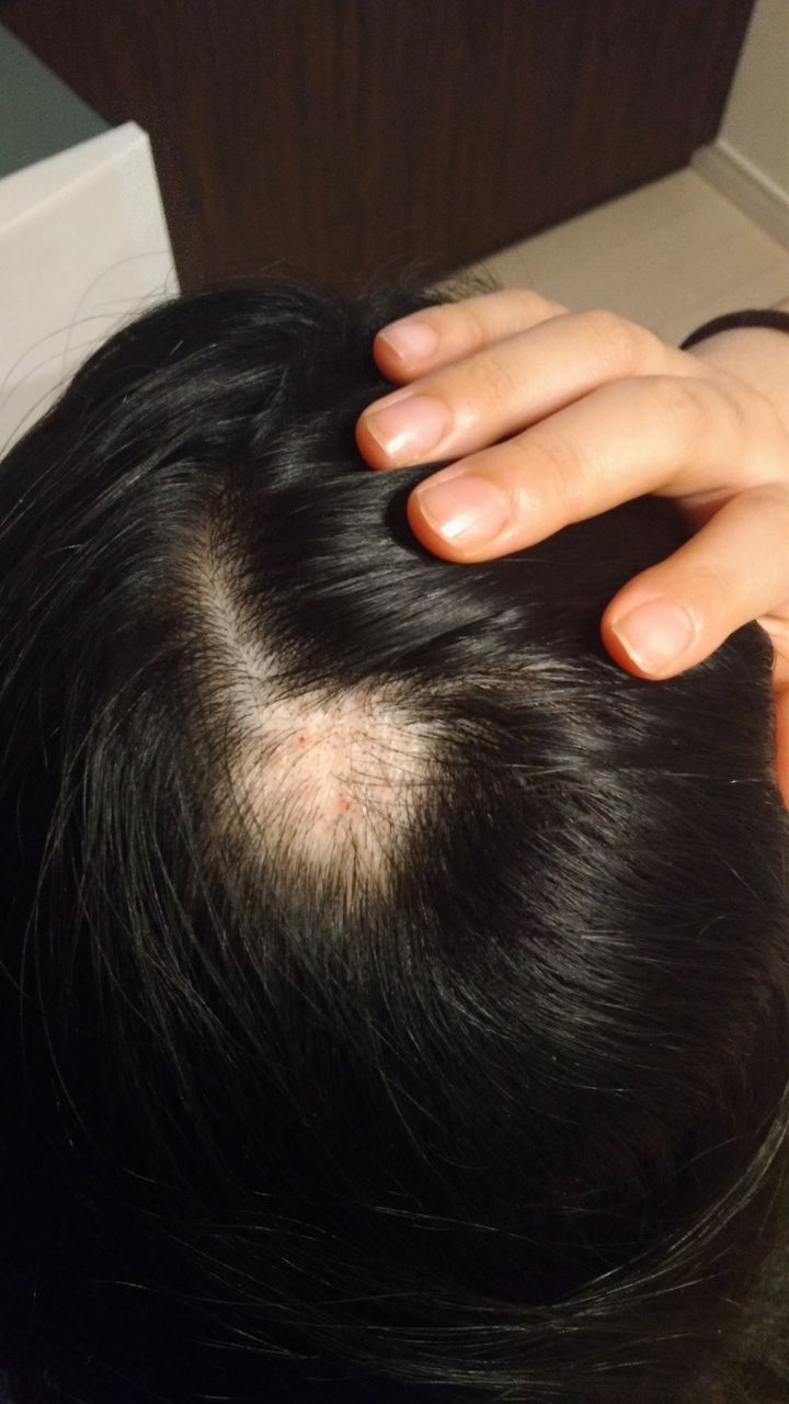 円形脱毛症 私の生活と実家の後始末