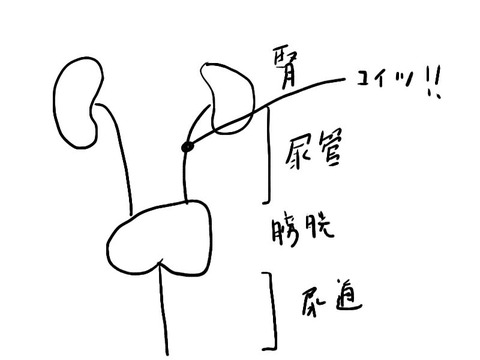 結石６
