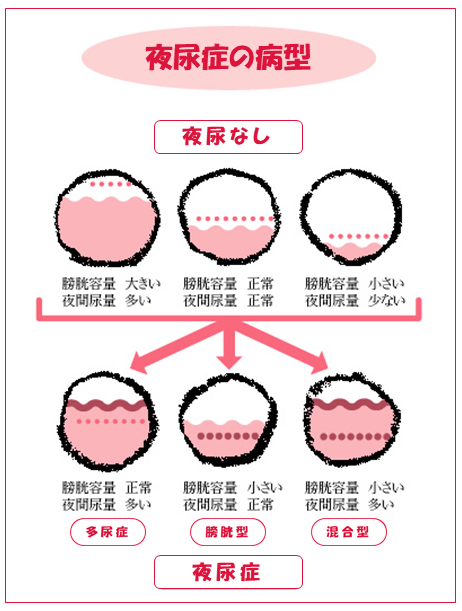 男性更年期障害と夜間頻尿：真実と誤解を解く