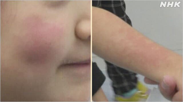 リンゴ病流行中！東京と埼玉での急増に迫る