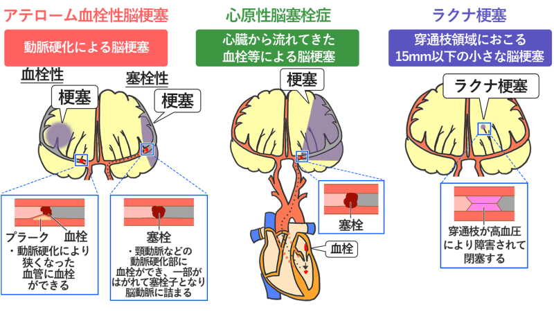 若年性脳梗塞の脅威：中高年にも影響する健康ガイド