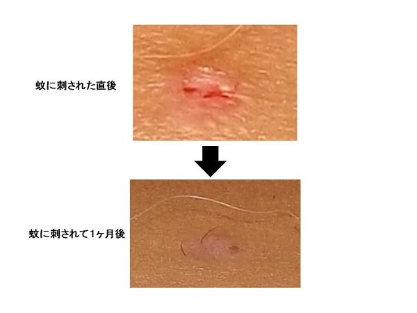 蚊に刺されたら要注意！デング熱とその合併症を徹底解説
