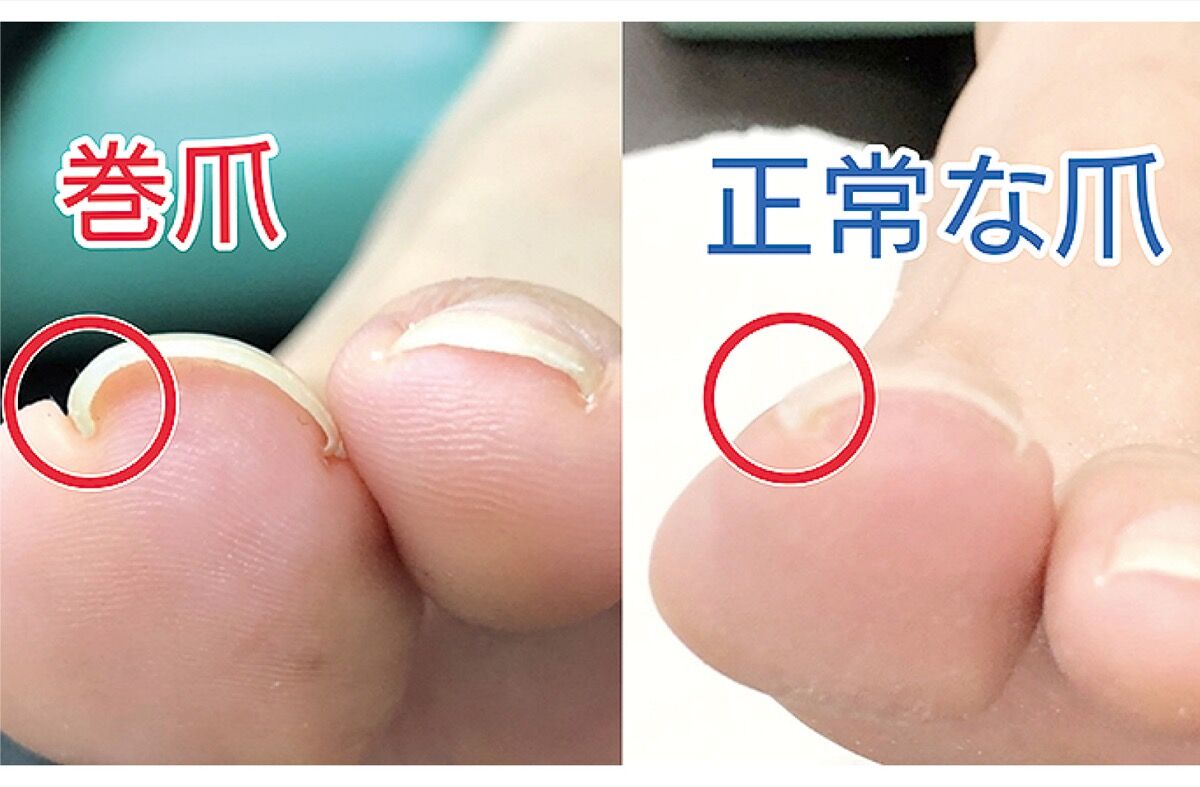 爪切りのポイントを知って、陥入爪を予防しよう！