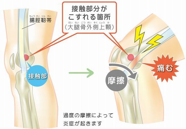 糖尿病管理に役立つ！膝痛を考慮した運動療法の実践ガイド