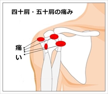 タオルでできる！四十肩を撲滅する簡単エクササイズ