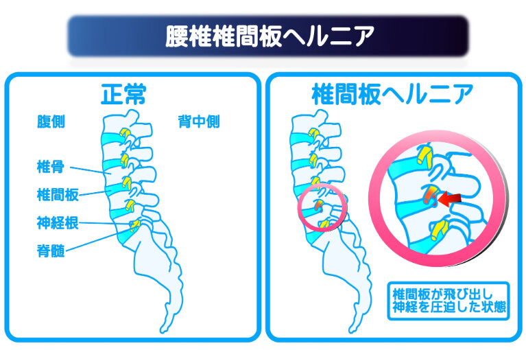激痛を乗り越えて：もう中学生の椎間板ヘルニア体験記