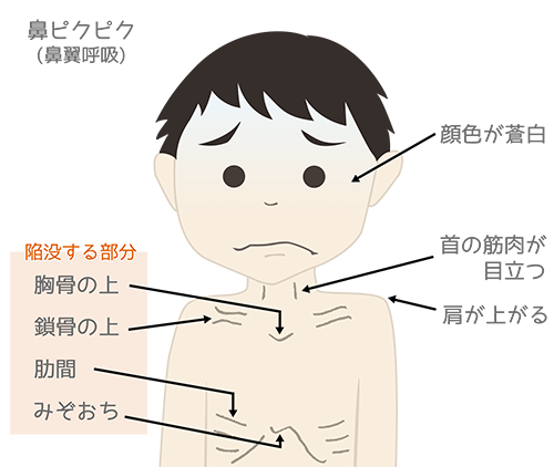 ゼーゼーしたら要注意！ヒトメタニューモウイルス感染症の症状と検査のすすめ