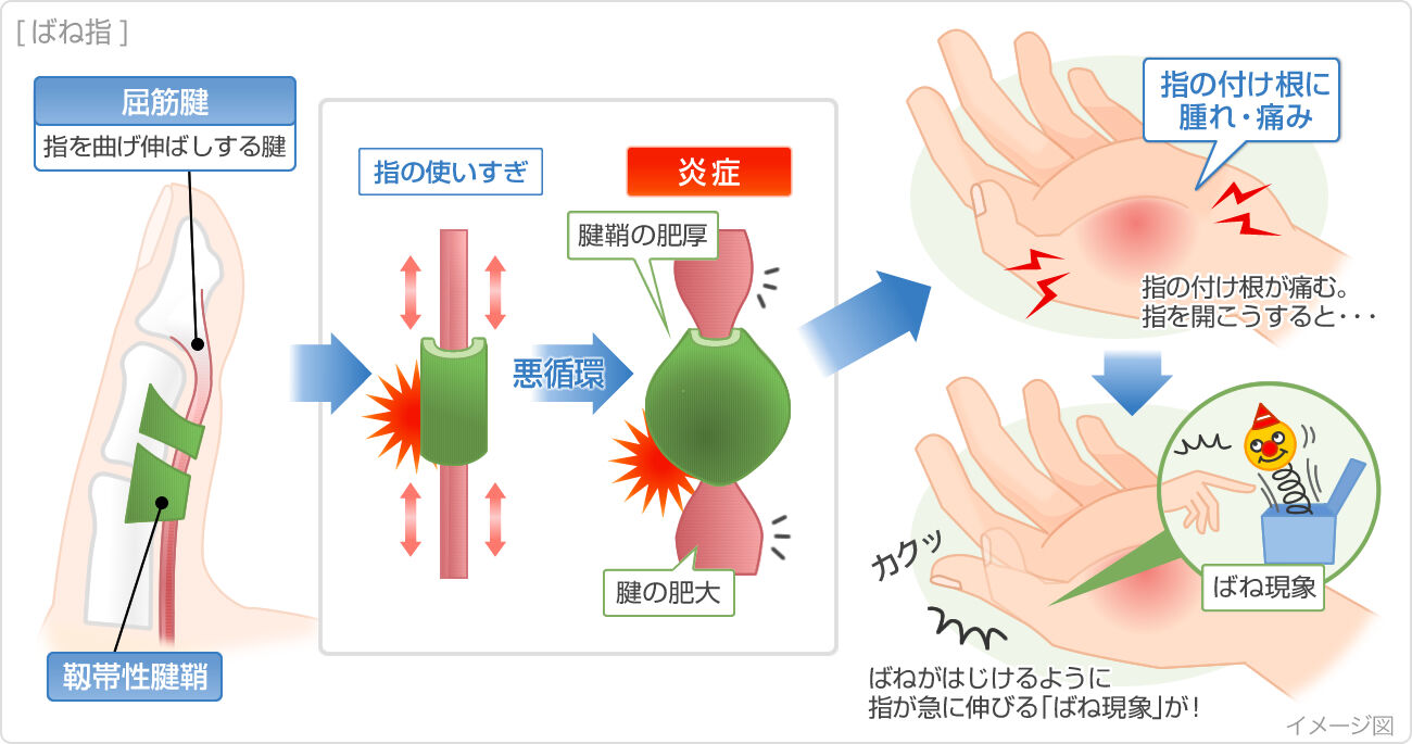 スマホ使い過ぎで腱鞘炎に？40代以上の女性に増えるリスクとは