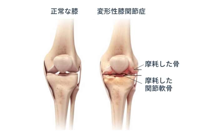 変形性膝関節症の原因と症状を徹底解説！あなたのリスクを知ろう