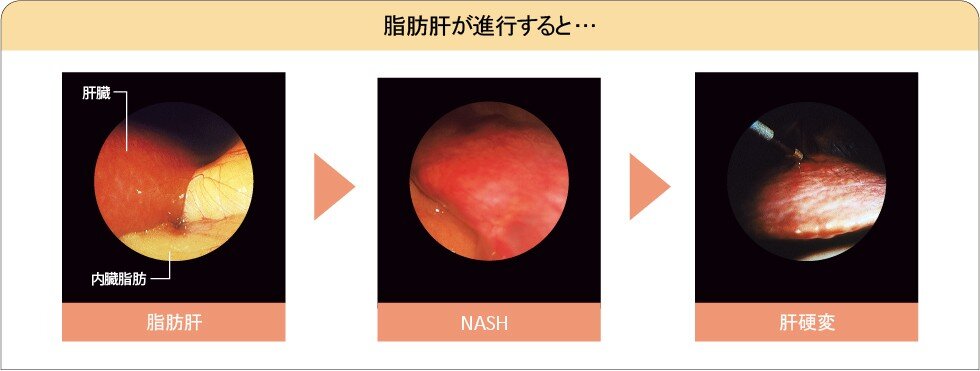 肝臓病の理解を深める：代謝異常と非アルコール性脂肪肝炎