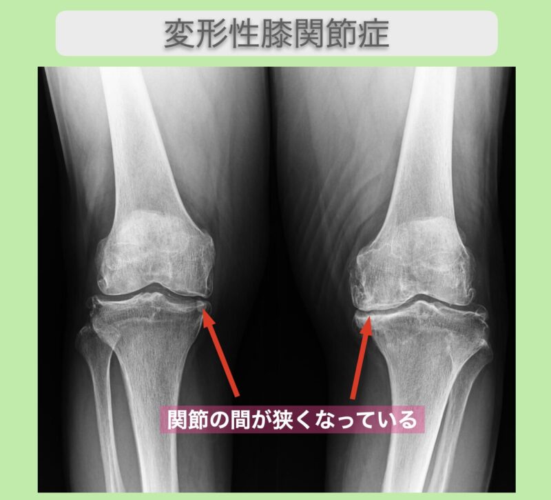 変形性膝関節症を理解しよう：原因・症状・対処法を徹底解説