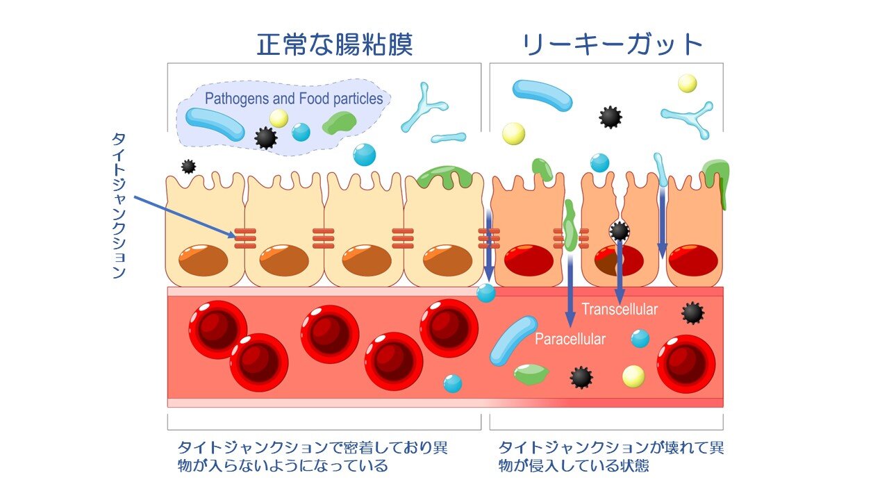 タンパク質をプロテインで補うべきか？リーキーガット症候群との関係