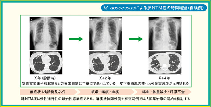 肺NTM症とは？中高年女性に多い感染症の実態