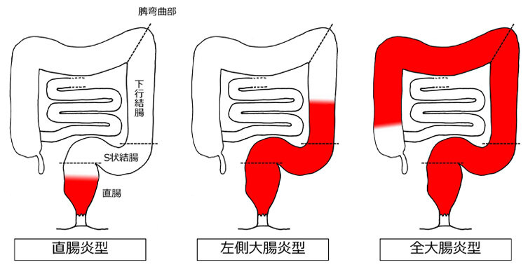 潰瘍性大腸炎とクローン病を知ろう！医師が教える症状と食事のポイント