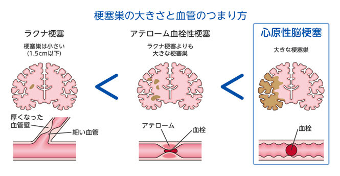脳梗塞を経て気づいたこと：忙しさが招いた後悔と教訓