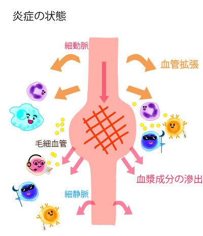 加齢と炎症：がんや認知症を防ぐための知識