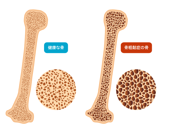 骨密度を高める厚揚げの魅力：栄養素と簡単レシピ