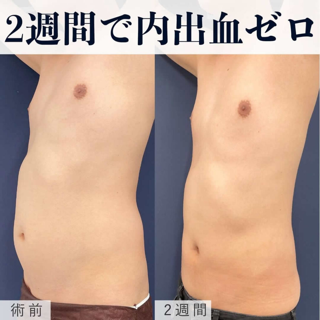 筋トレなしで得られるアスリート体型！マッスル脂肪吸引の真実