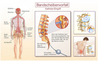 写真 腰痛 椎間板ヘルニア 3 (384x240)